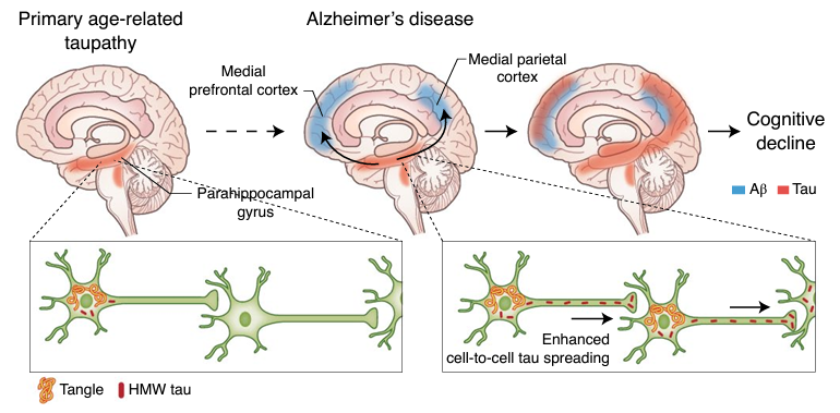 Depiction of experimental model of amyloid β (Aβ) and tau protein synergy in propagating Alzheimer’s disease. Aβ plaques accelerate tau spreading and cognitive decline in Alzheimer’s disease (Busche & Hyman; Synergy between amyloid-β and tau in Alzheimer’s disease. Nature Neuroscience; 23, 1183–1193; 2020).